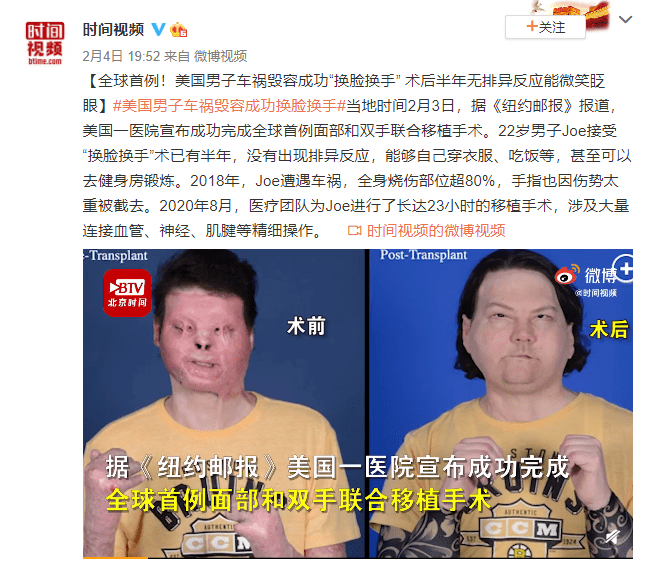 全球首例成功换脸换手男子将结婚——重塑人生，迈向幸福