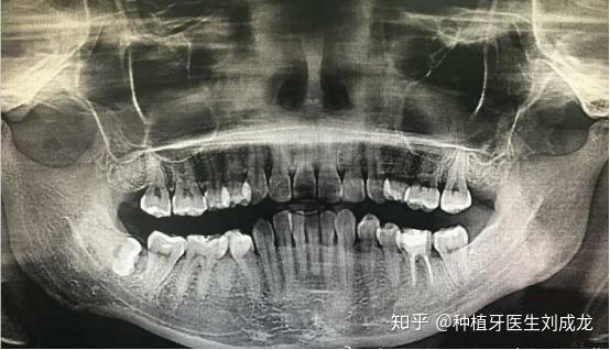 河南拔智齿，从网络热梗到全民热议的医学探索